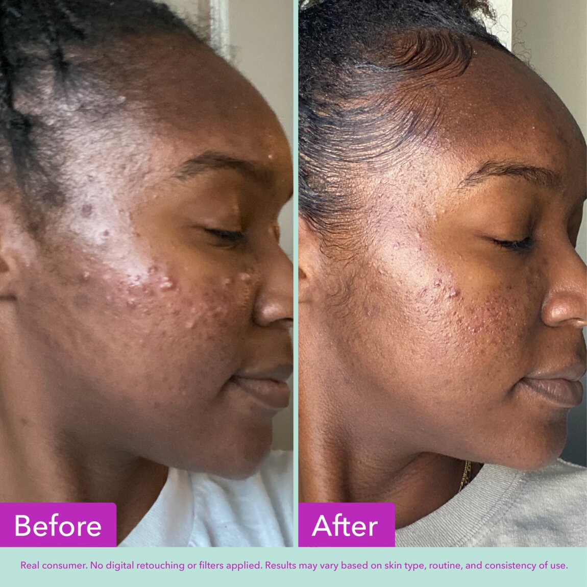 acne-foaming-cleanser-l3 zb_p.jpg